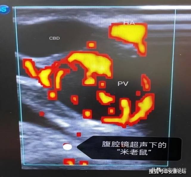 迈瑞医疗获得发明专利授权：“腹腔镜超声探头及用于与腹腔镜通信连接的超声设备”